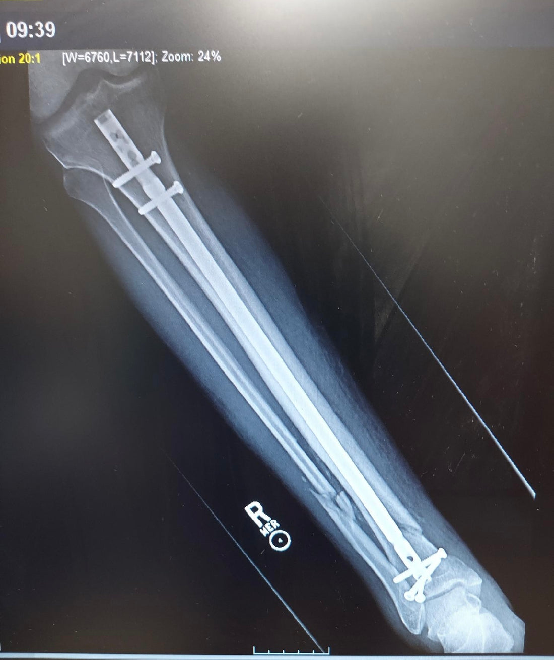 Learning to Walk Again (I believe I’ve waited long enough 🎵)
